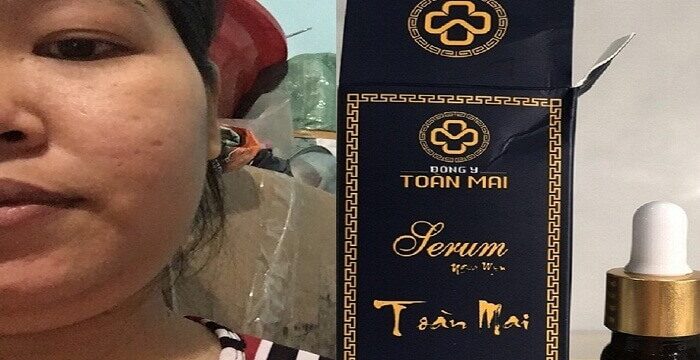 Serum Ngừa Mụn Toàn Mai