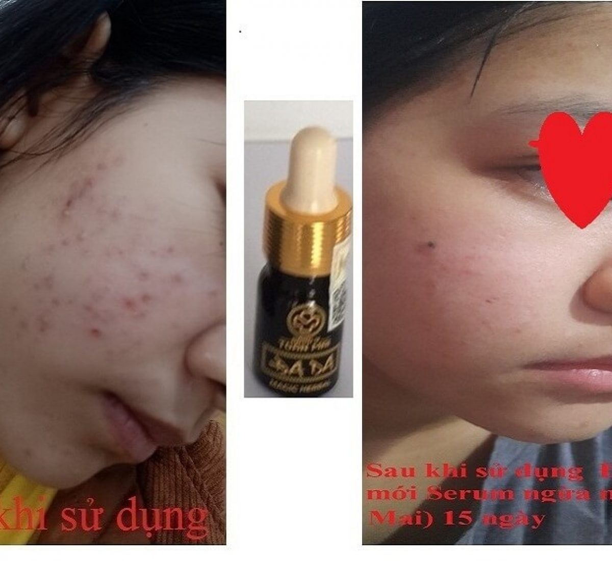 Hinh  Bé Gái bị mụn ở mặt Hinh  Bé Gái bị mụn ở mặt