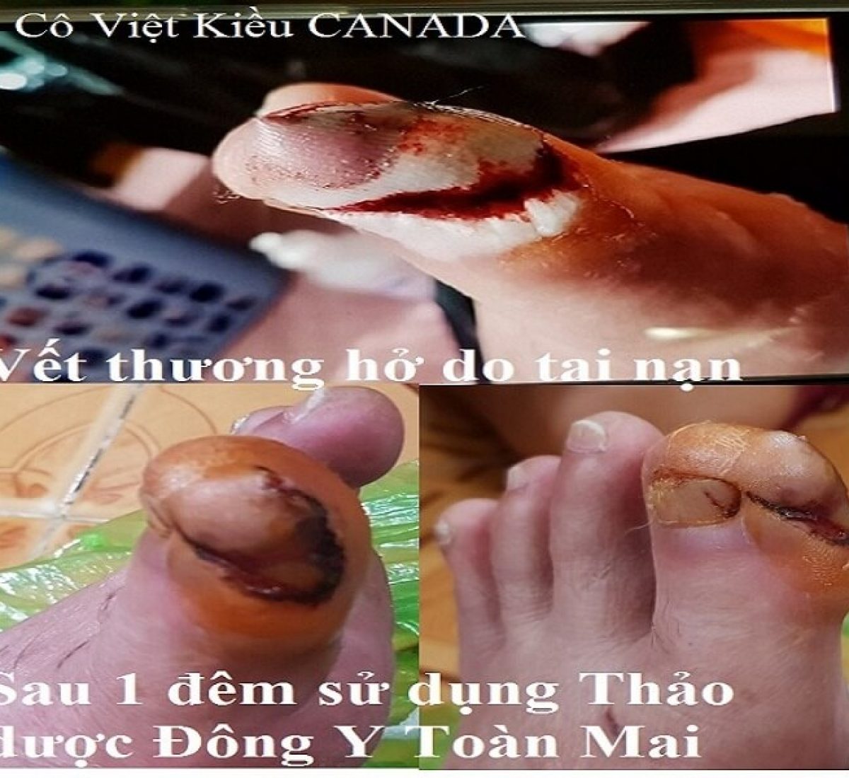 hinh cô Việt Kiều Canada tai nạn ngón chân hinh cô Việt Kiều Canada tai nạn ngón chân