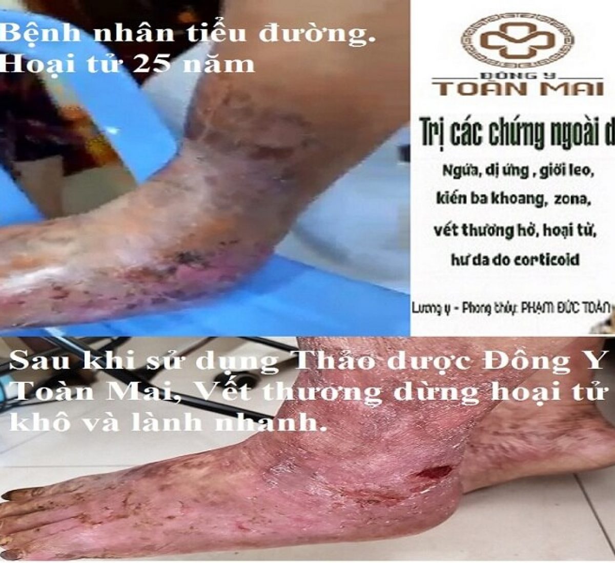 Hinh trang chủ hoại tử tiểu đường 25 năm Hình trang chủ hoại tử tiểu đường 25 năm