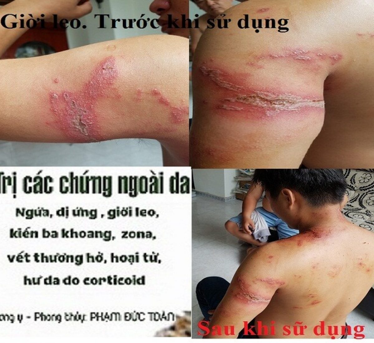 hinh bệnh nhân giời leo ở cổ và tay hinh bệnh nhân giời leo ở cổ và tay