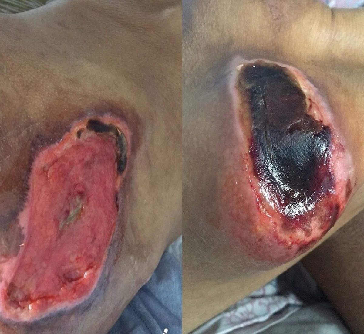 Hinh  hình trang chủ hoại tử tiểu đường tới xương Hình trang chủ hoại tử tiểu đường tới xương