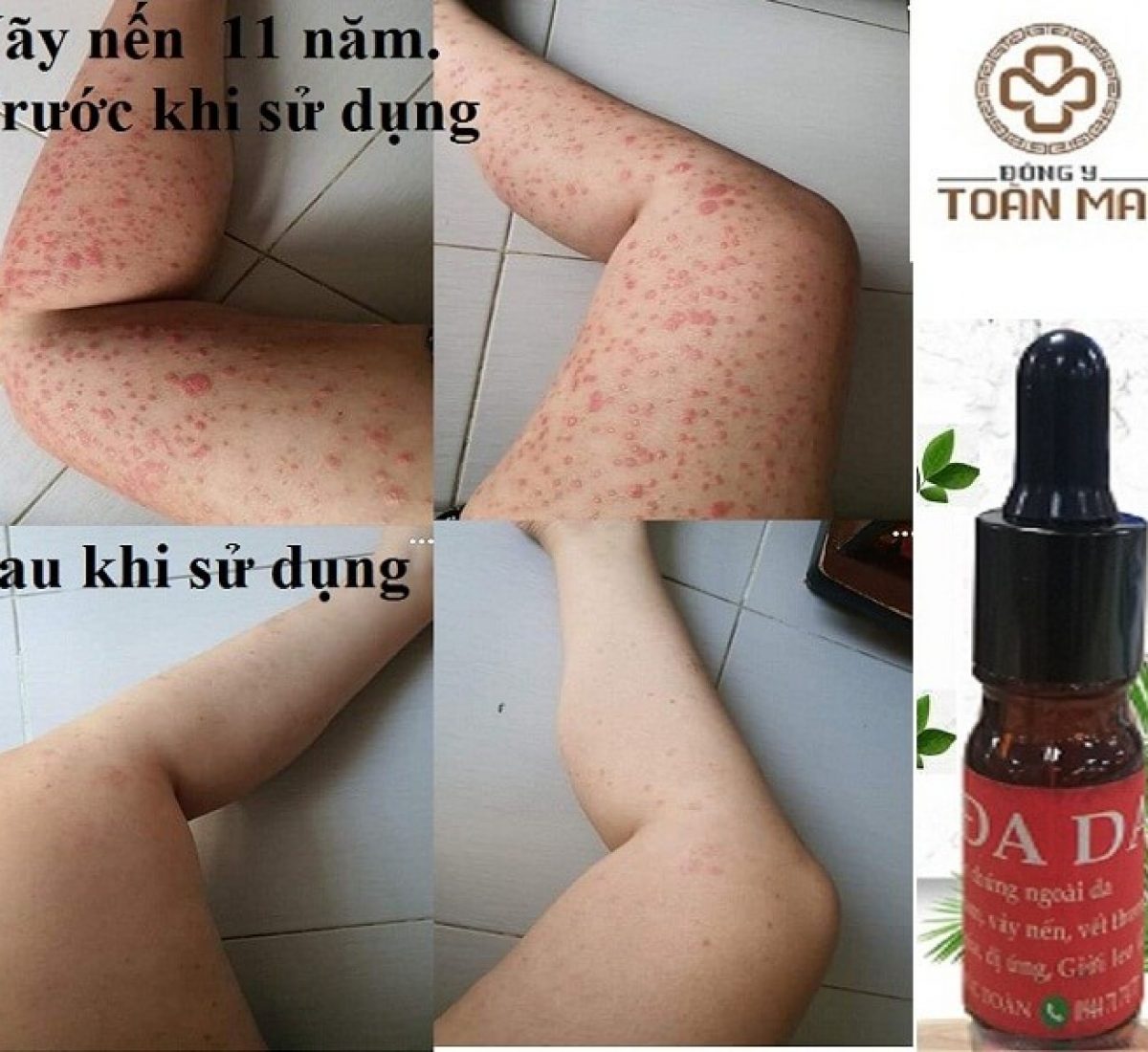 hinh trang chủ Bé gái bị vãy nến Hình trang chủ Bé gái bị vãy nến