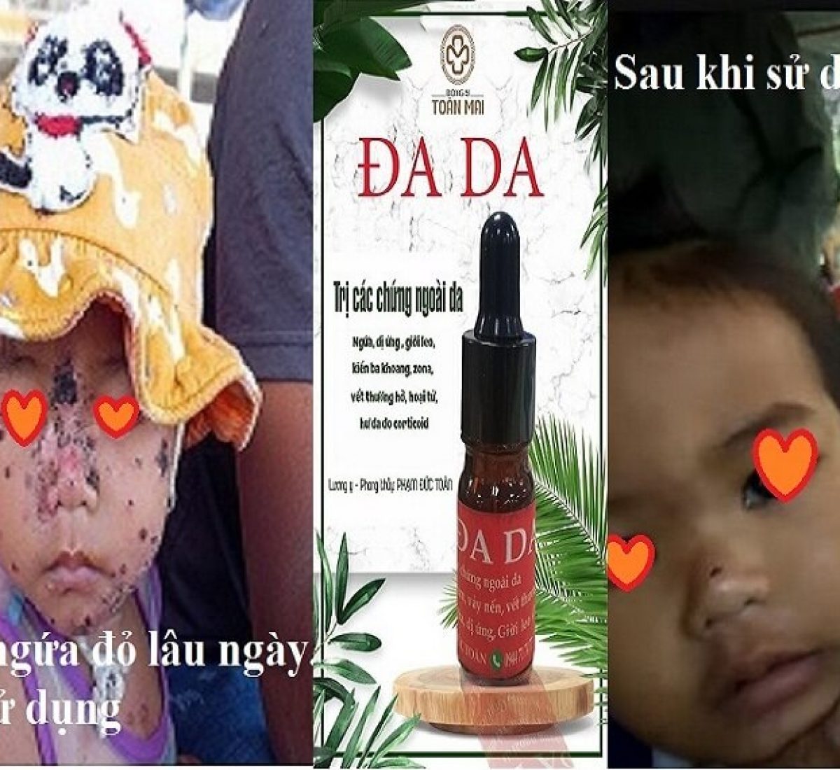 hinh  Bé dân tộc ngứa đỏ toàn thân hinh  Bé dân tộc ngứa đỏ toàn thân