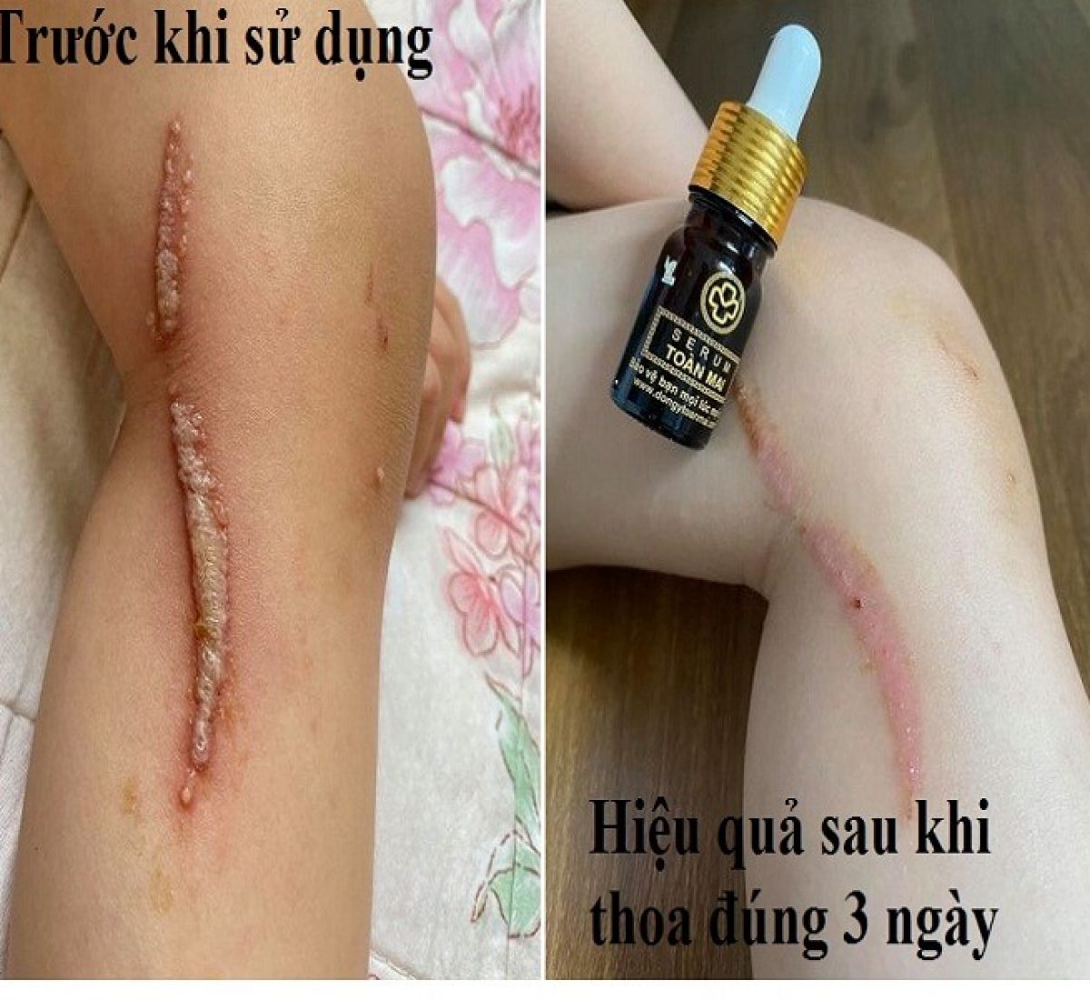 hinh trang chủ Bé gái Kiến Ba Khoang cắn Hình trang chủ Bé gái kiến Ba Khoang cắn