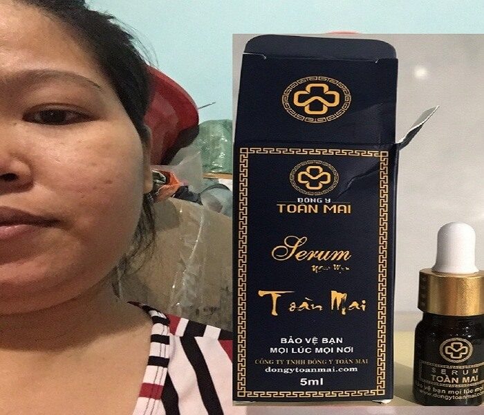 Serum Ngừa Mụn Toàn Mai 1 (1) Serum Ngừa Mụn Toàn Mai 1 (1)